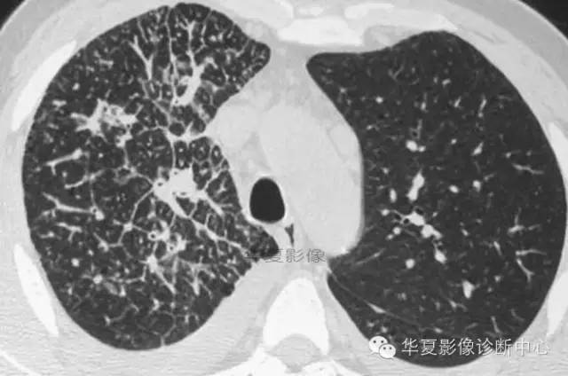典型影像征象收集