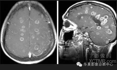 典型影像征象收集