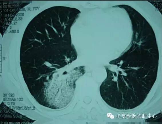 典型影像征象收集