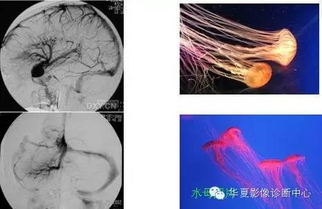 典型影像征象收集