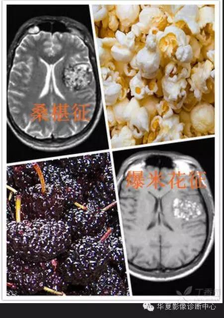 典型影像征象收集