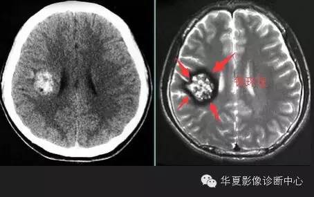 典型影像征象收集