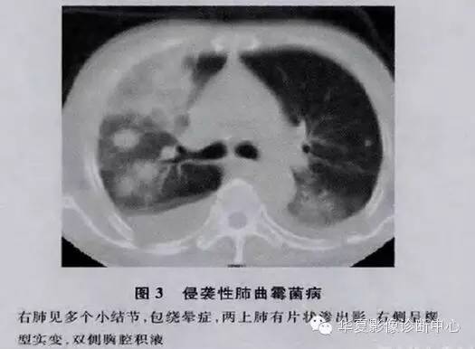 典型影像征象收集