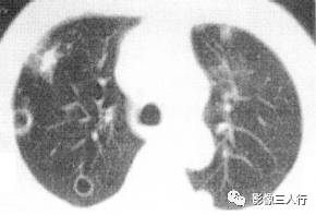 “空泡征” 的影像表现与临床意义