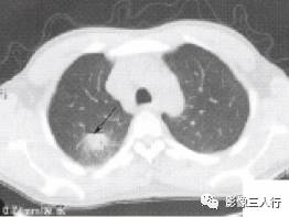 “空泡征” 的影像表现与临床意义