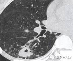 “空泡征” 的影像表现与临床意义