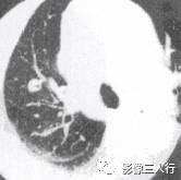 “空泡征” 的影像表现与临床意义