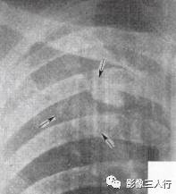 “空泡征” 的影像表现与临床意义