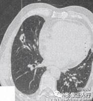 “空泡征” 的影像表现与临床意义 “空泡征” 的影像表现与临床意义