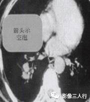 “空泡征” 的影像表现与临床意义