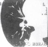 “空泡征” 的影像表现与临床意义