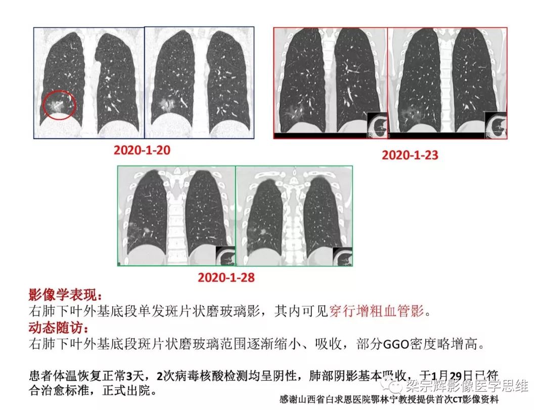 【PPT】山西新型冠状病毒肺炎影像学表现初探