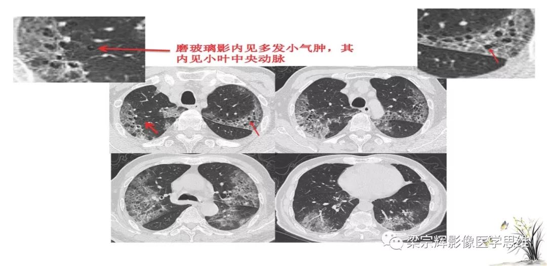 【PPT】山西新型冠状病毒肺炎影像学表现初探