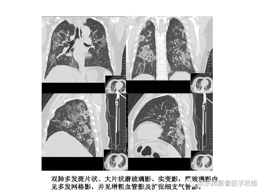 【PPT】山西新型冠状病毒肺炎影像学表现初探