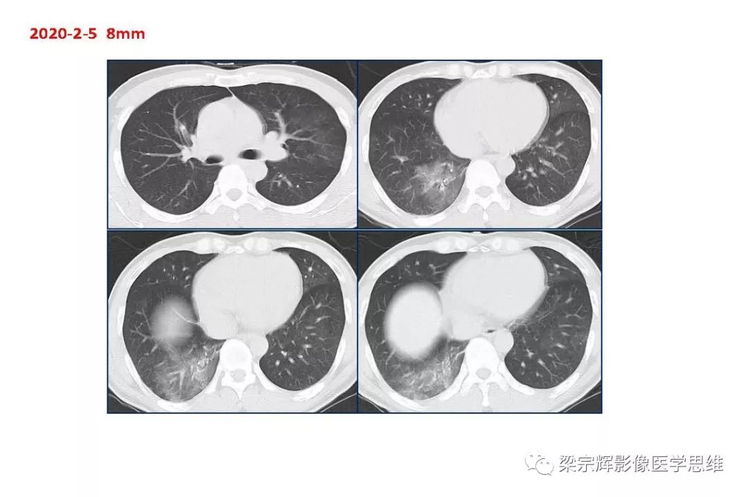【PPT】山西新型冠状病毒肺炎影像学表现初探