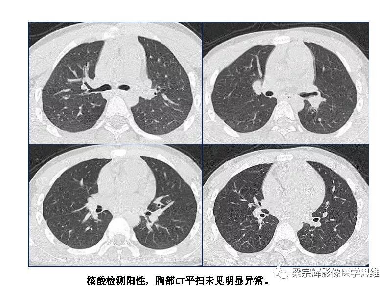【PPT】山西新型冠状病毒肺炎影像学表现初探
