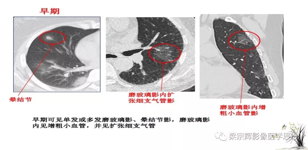 【PPT】山西新型冠状病毒肺炎影像学表现初探