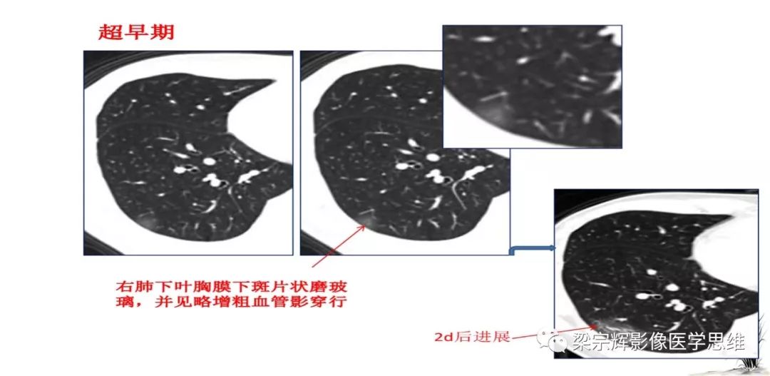 【PPT】山西新型冠状病毒肺炎影像学表现初探