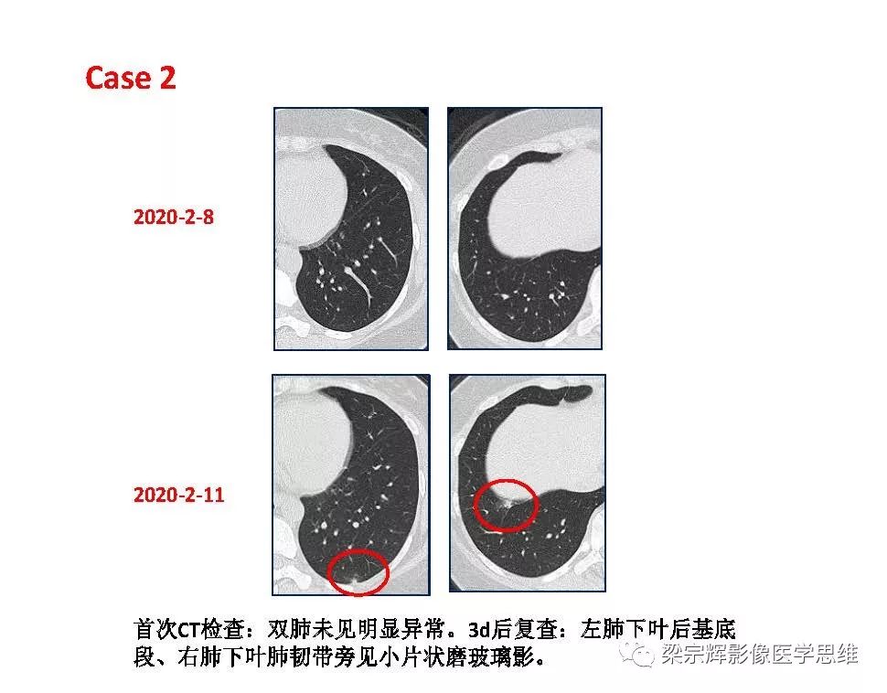 【PPT】山西新型冠状病毒肺炎影像学表现初探