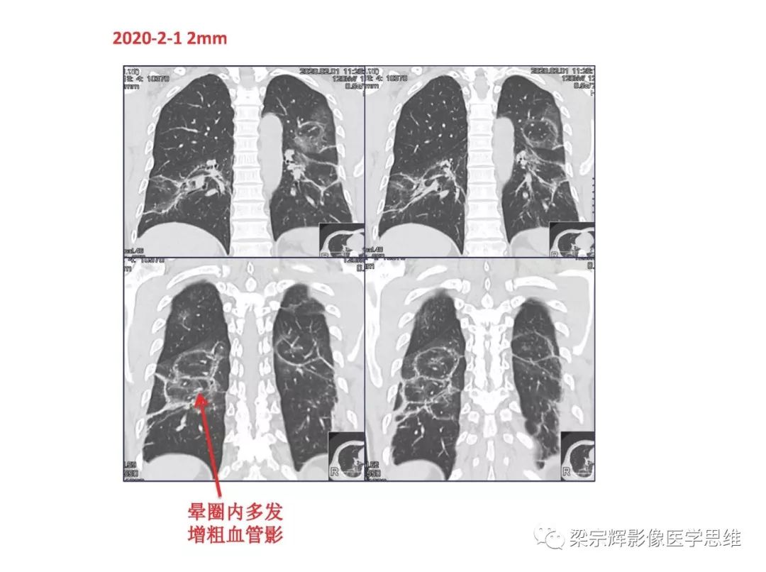 【PPT】山西新型冠状病毒肺炎影像学表现初探