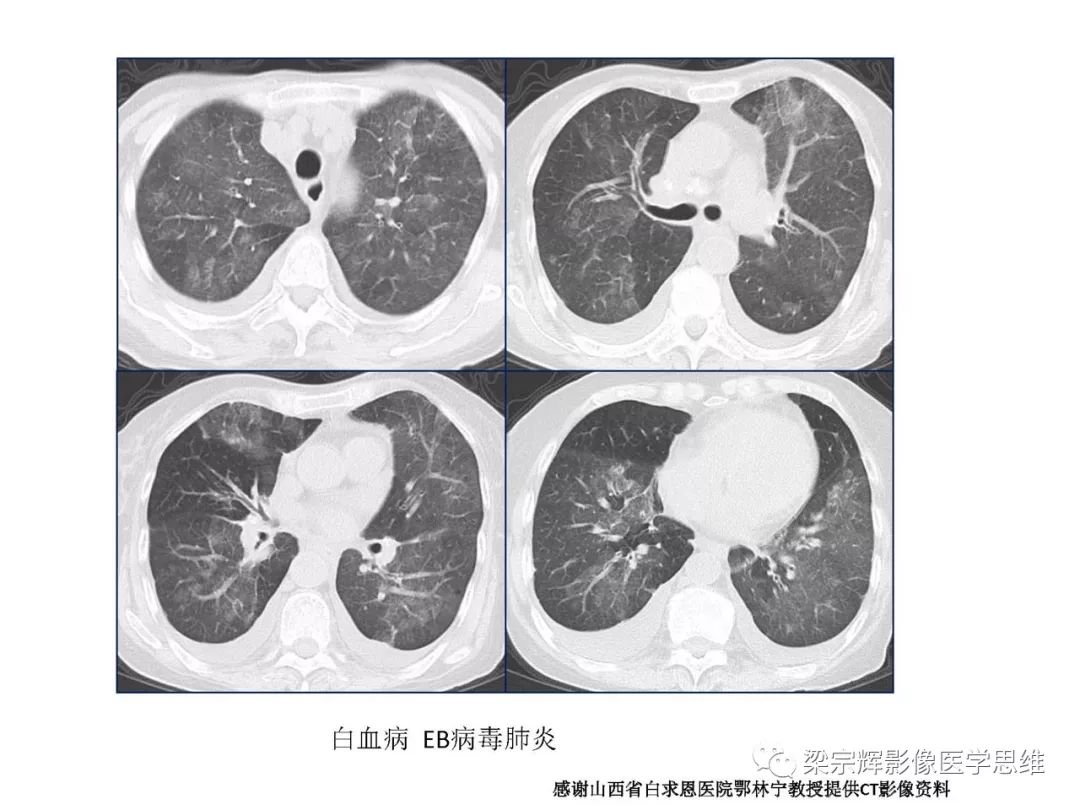 【PPT】山西新型冠状病毒肺炎影像学表现初探
