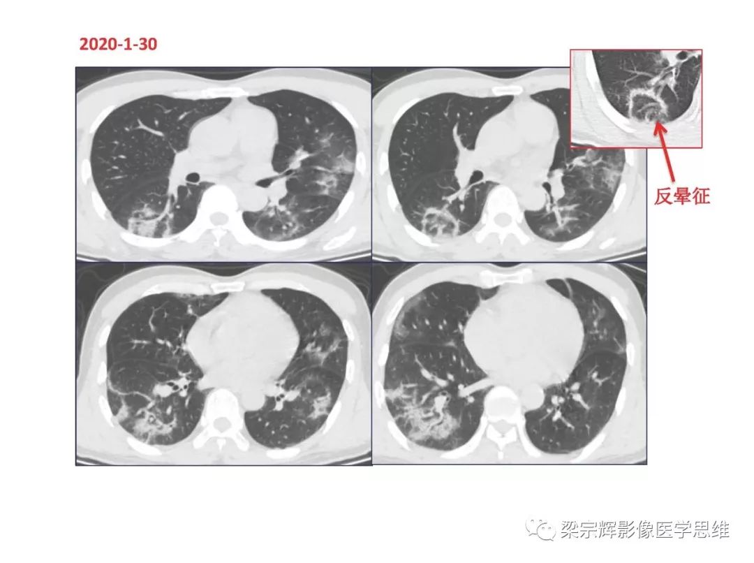 【PPT】山西新型冠状病毒肺炎影像学表现初探