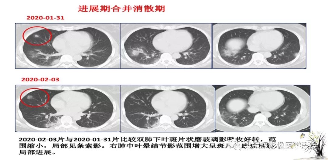 【PPT】山西新型冠状病毒肺炎影像学表现初探
