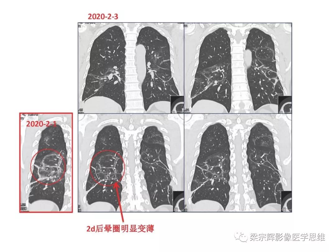 【PPT】山西新型冠状病毒肺炎影像学表现初探
