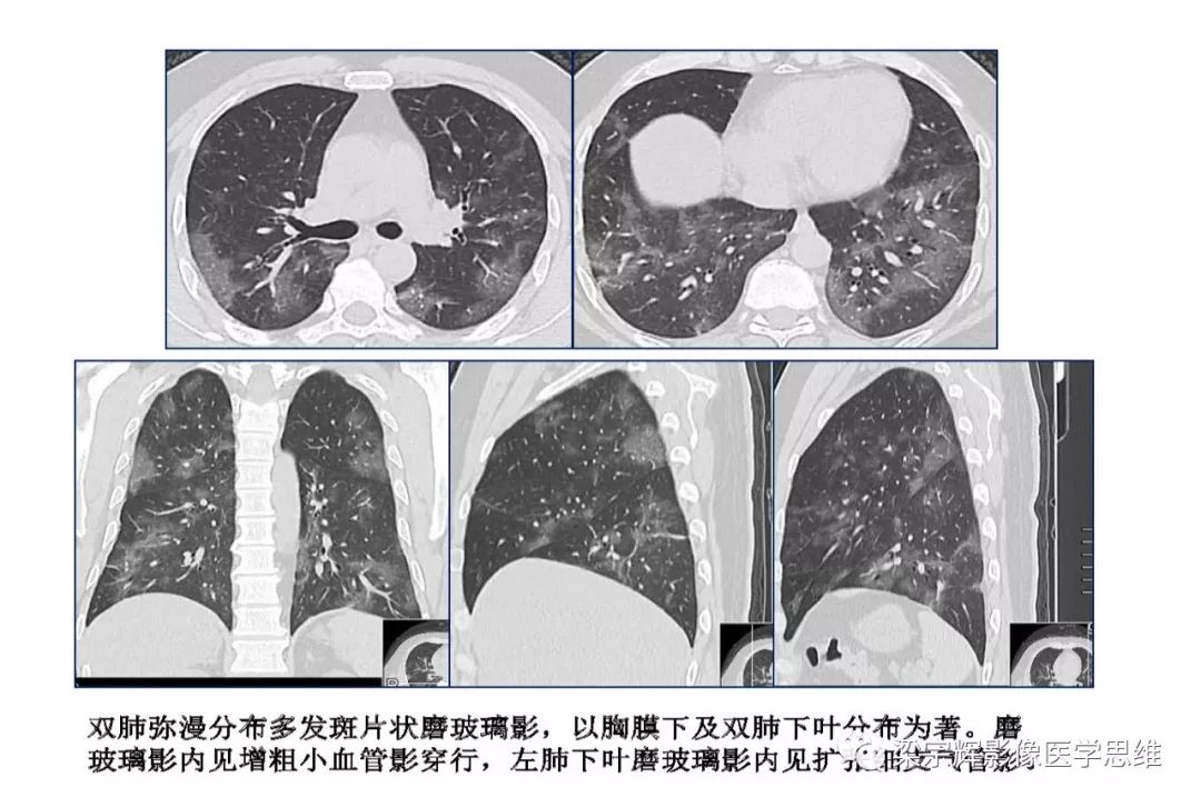 【PPT】山西新型冠状病毒肺炎影像学表现初探