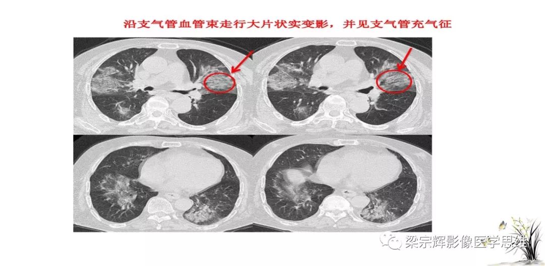 【PPT】山西新型冠状病毒肺炎影像学表现初探
