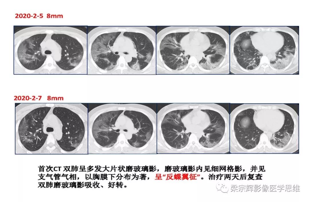 【PPT】山西新型冠状病毒肺炎影像学表现初探