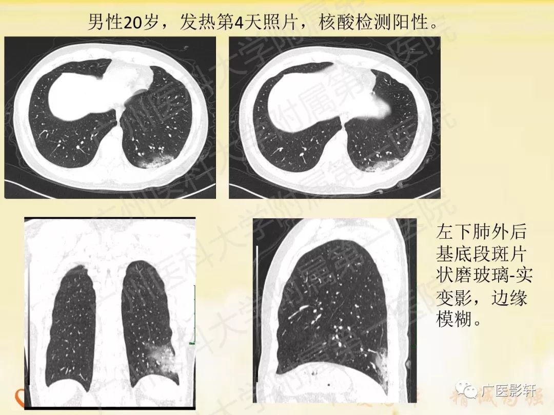 【PPT】新型冠状病毒肺炎影像学特点 【PPT】新型冠状病毒肺炎影像学特点