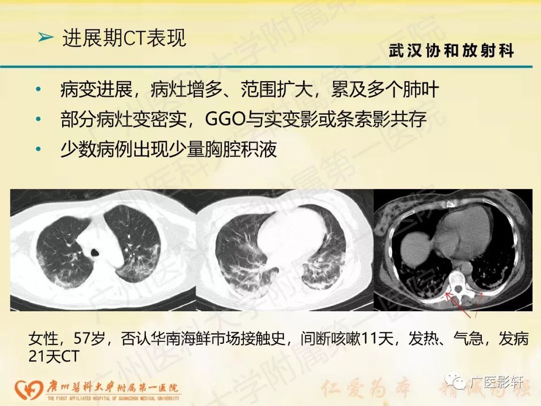 【PPT】新型冠状病毒肺炎影像学特点 【PPT】新型冠状病毒肺炎影像学特点