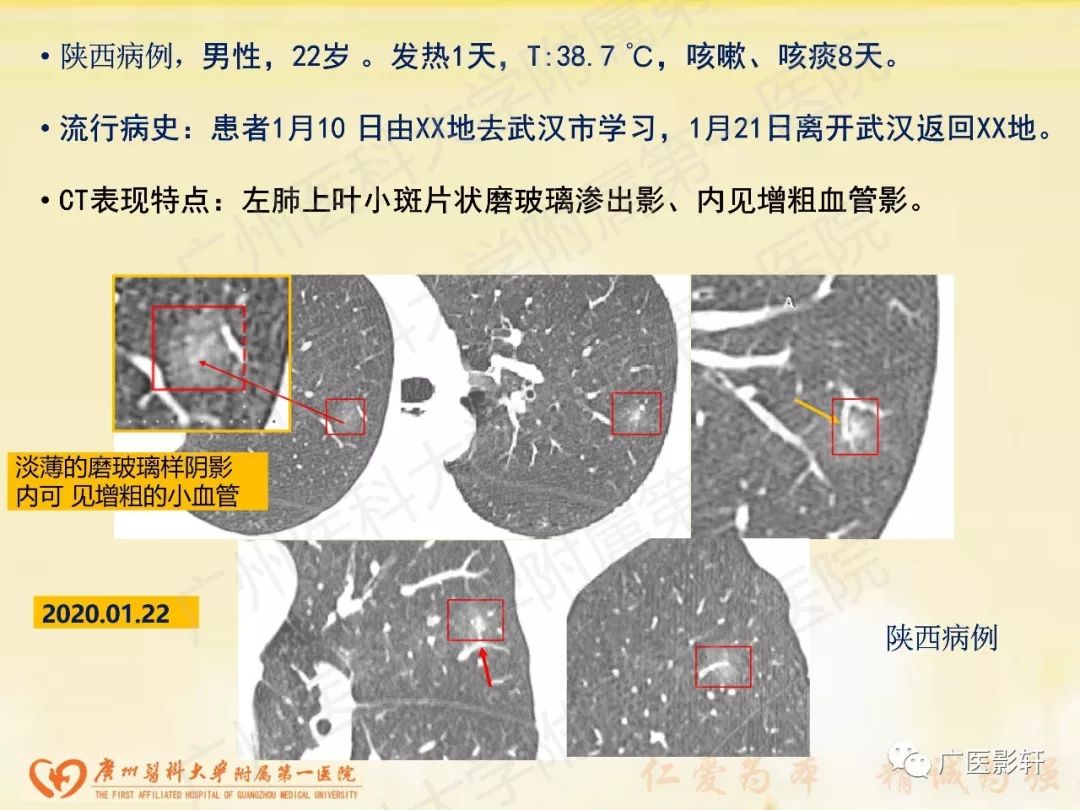 【PPT】新型冠状病毒肺炎影像学特点 【PPT】新型冠状病毒肺炎影像学特点