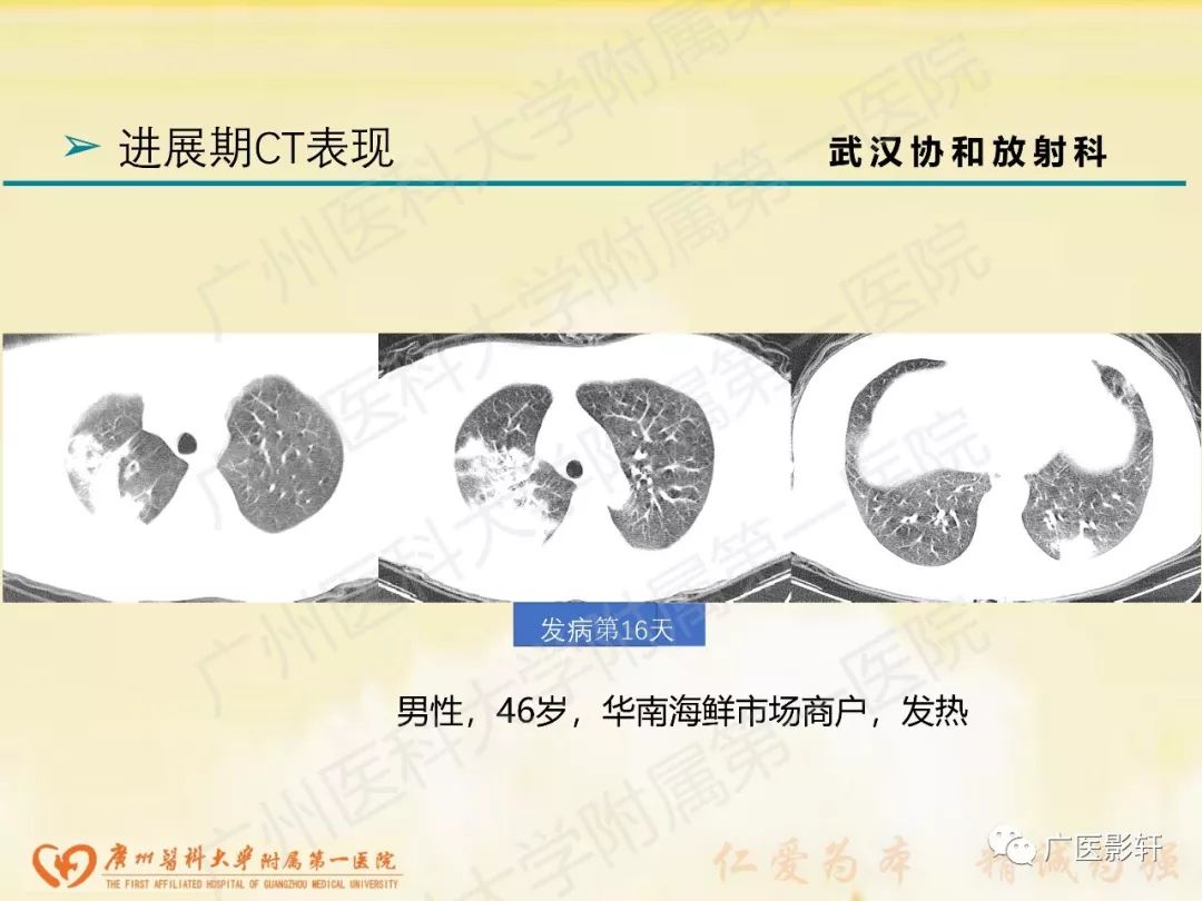 【PPT】新型冠状病毒肺炎影像学特点 【PPT】新型冠状病毒肺炎影像学特点
