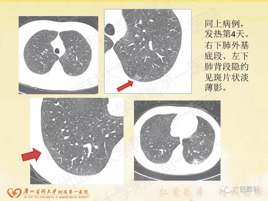 【PPT】新型冠状病毒肺炎影像学特点 【PPT】新型冠状病毒肺炎影像学特点
