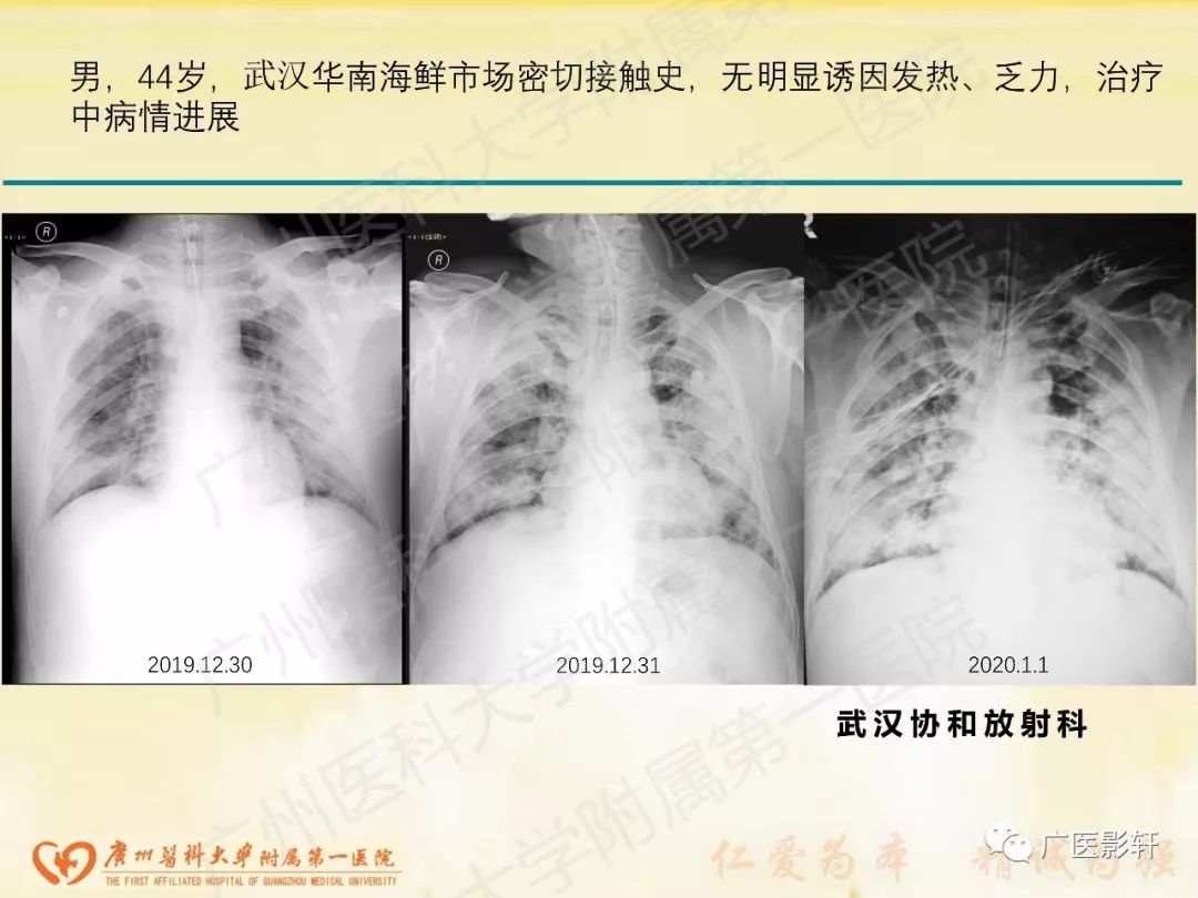 【PPT】新型冠状病毒肺炎影像学特点 【PPT】新型冠状病毒肺炎影像学特点