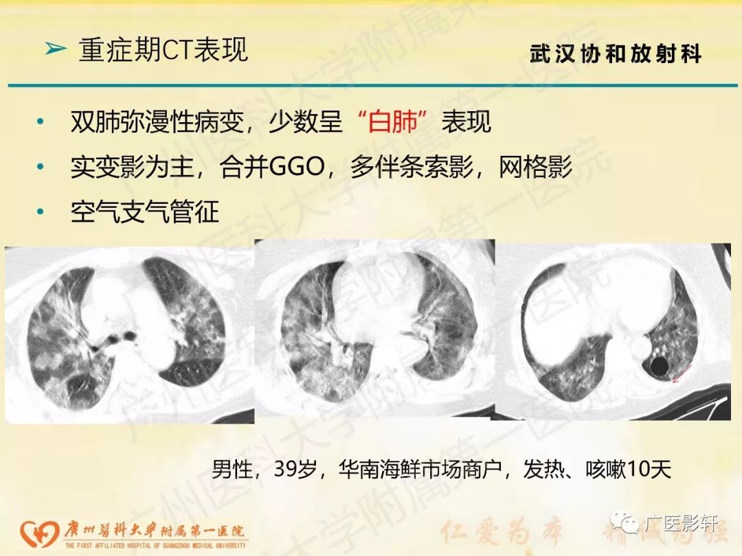 【PPT】新型冠状病毒肺炎影像学特点 【PPT】新型冠状病毒肺炎影像学特点