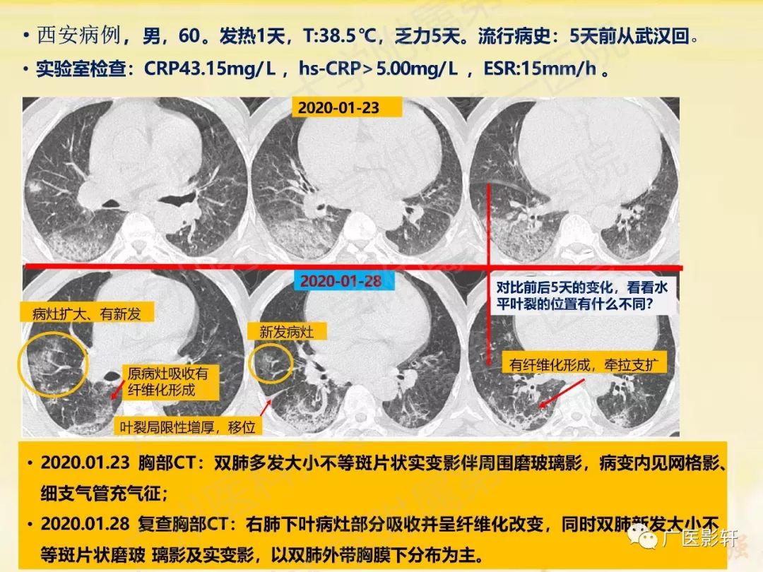 【PPT】新型冠状病毒肺炎影像学特点 【PPT】新型冠状病毒肺炎影像学特点