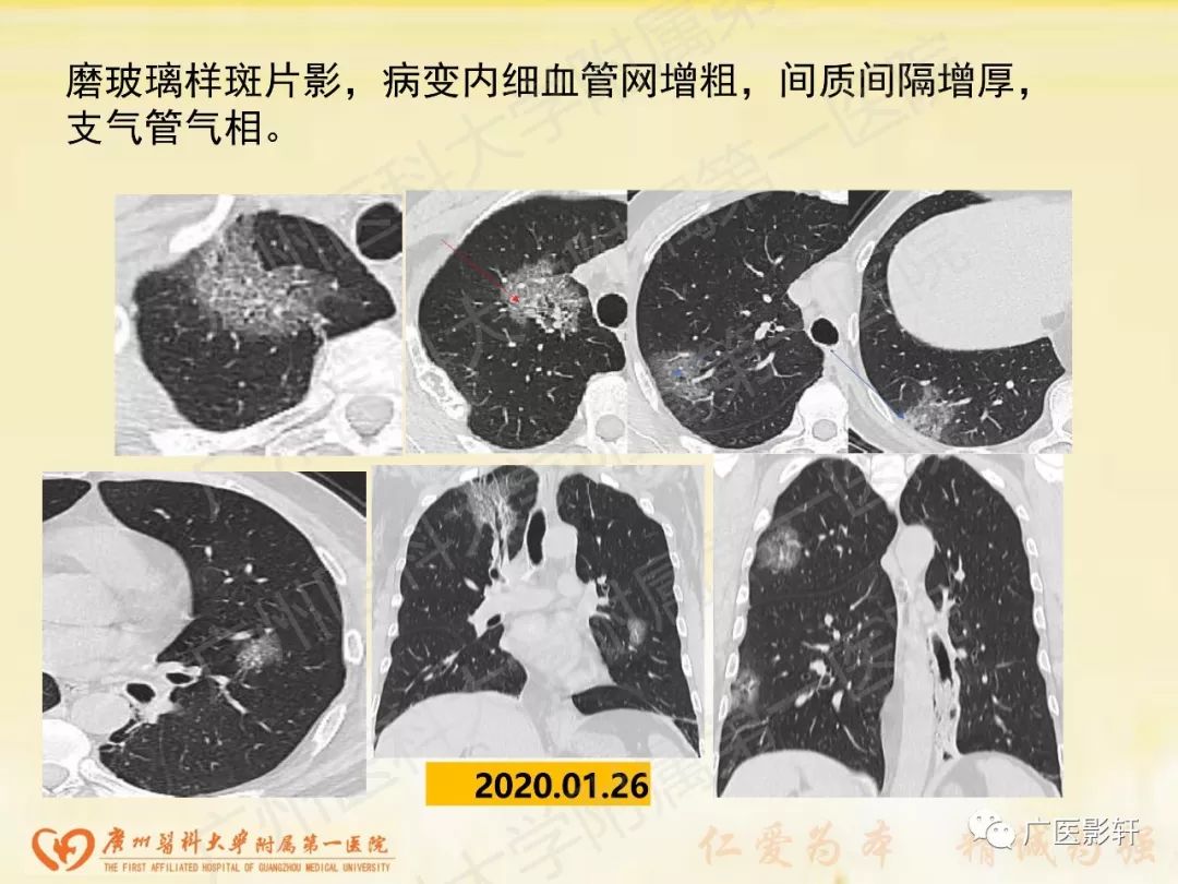 【PPT】新型冠状病毒肺炎影像学特点 【PPT】新型冠状病毒肺炎影像学特点