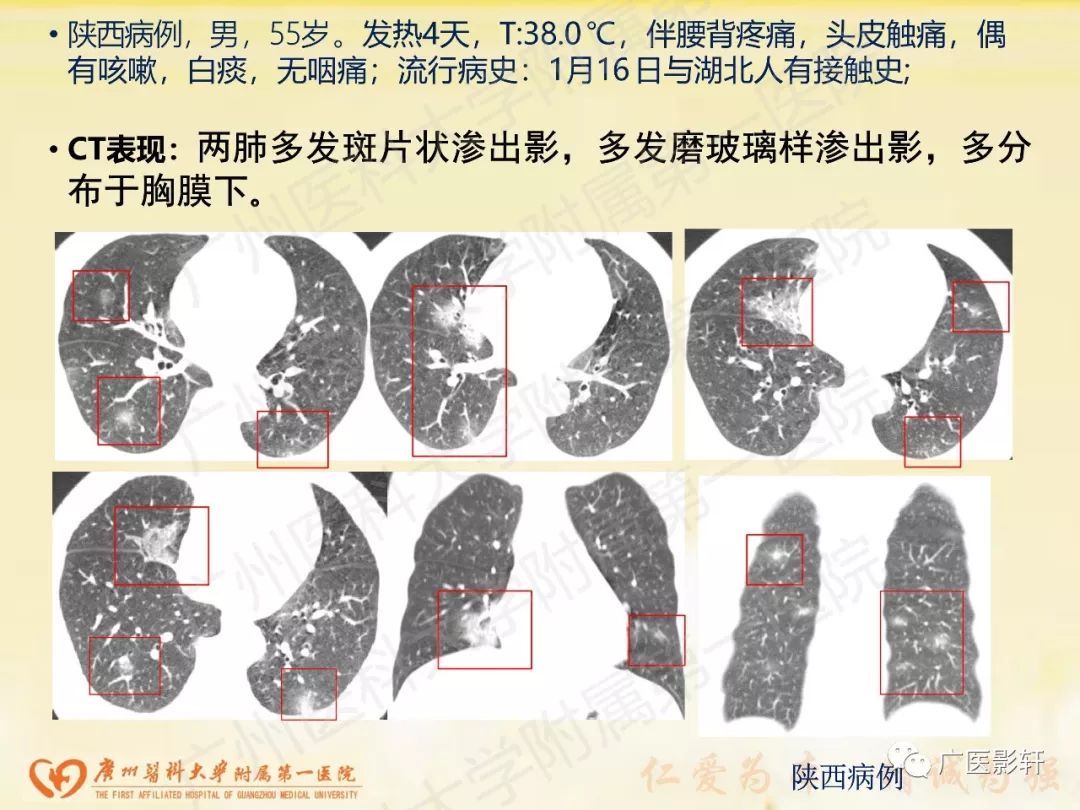 【PPT】新型冠状病毒肺炎影像学特点 【PPT】新型冠状病毒肺炎影像学特点