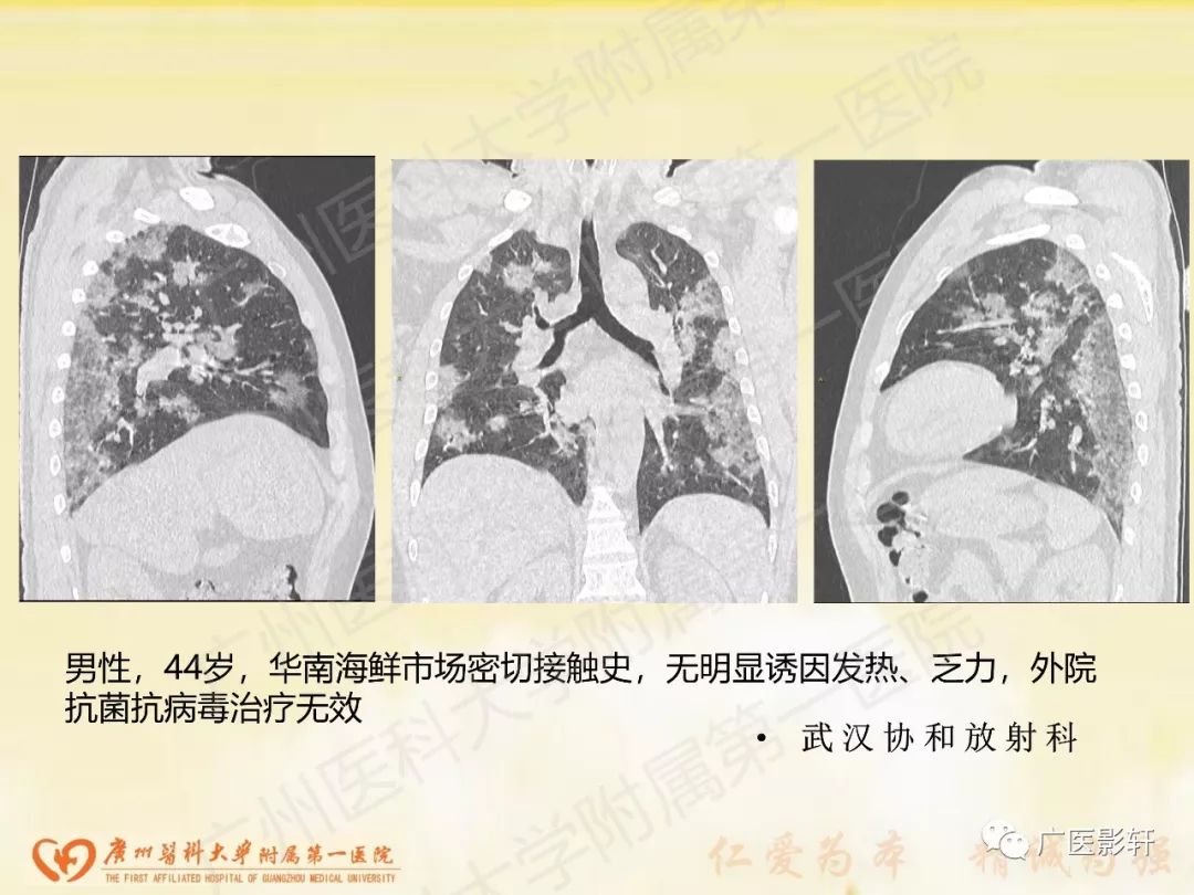 【PPT】新型冠状病毒肺炎影像学特点 【PPT】新型冠状病毒肺炎影像学特点