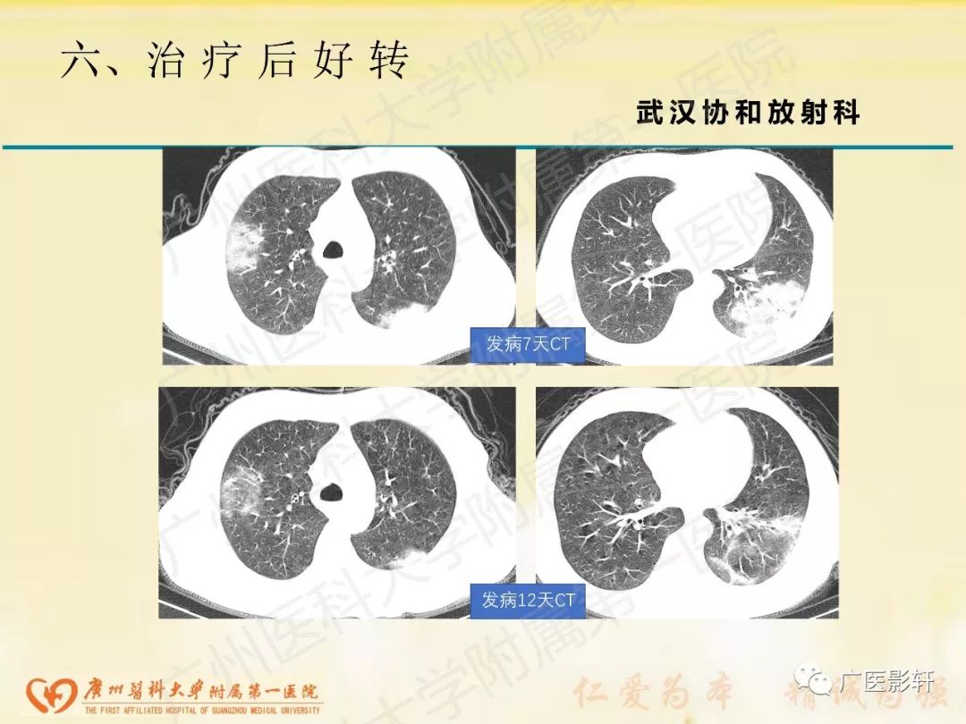 【PPT】新型冠状病毒肺炎影像学特点 【PPT】新型冠状病毒肺炎影像学特点