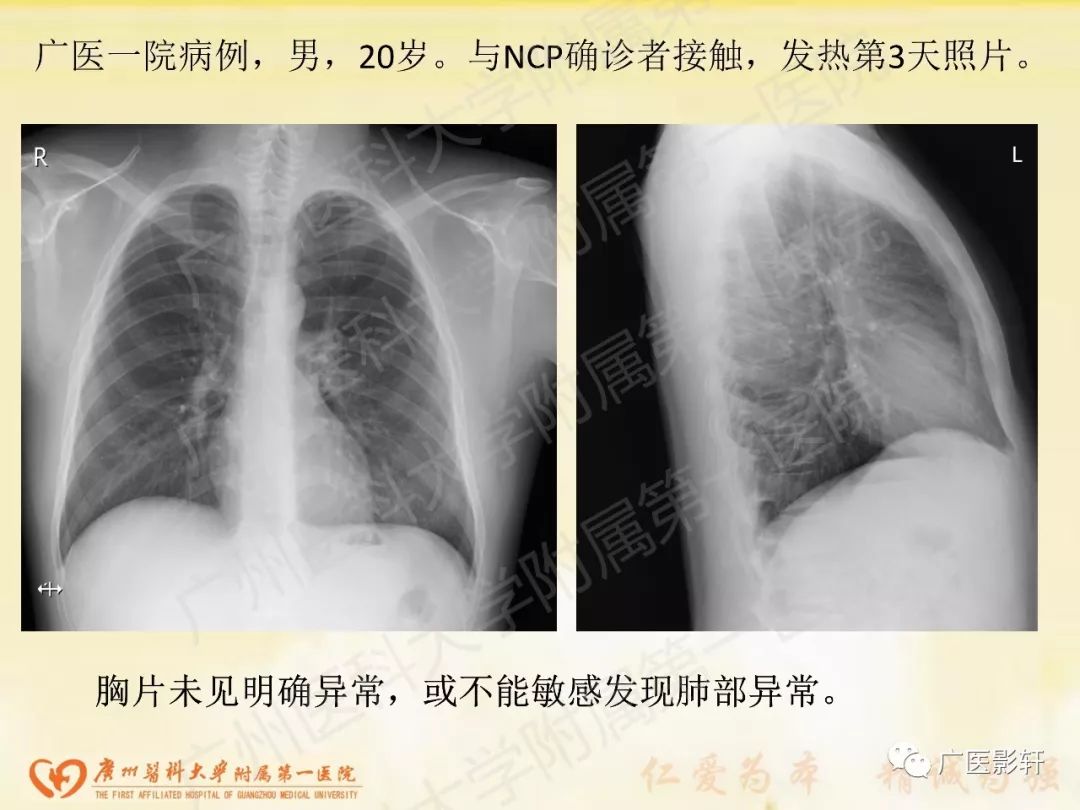 【PPT】新型冠状病毒肺炎影像学特点 【PPT】新型冠状病毒肺炎影像学特点