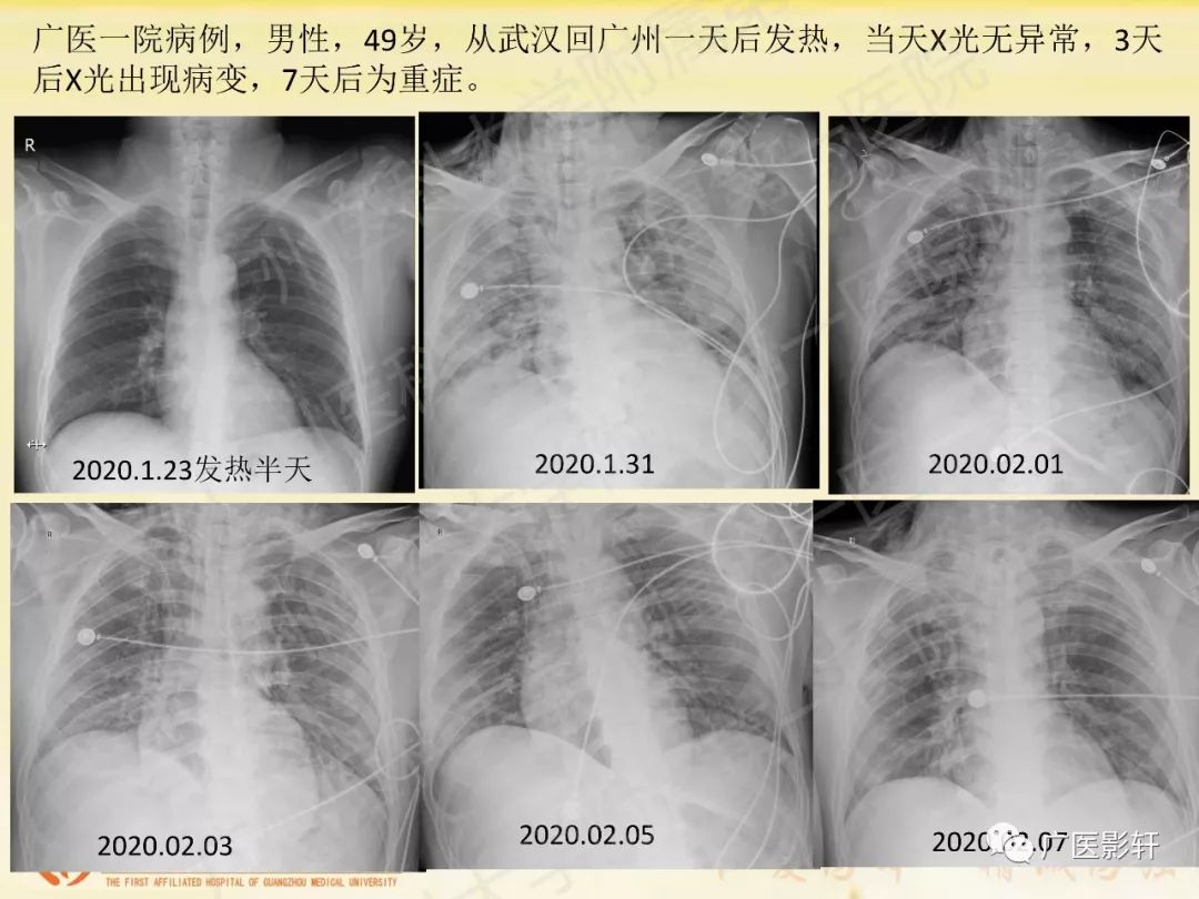 【PPT】新型冠状病毒肺炎影像学特点 【PPT】新型冠状病毒肺炎影像学特点