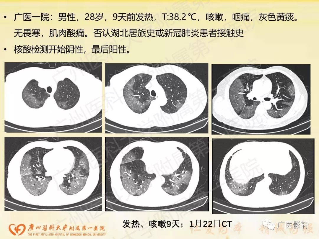 【PPT】新型冠状病毒肺炎影像学特点 【PPT】新型冠状病毒肺炎影像学特点
