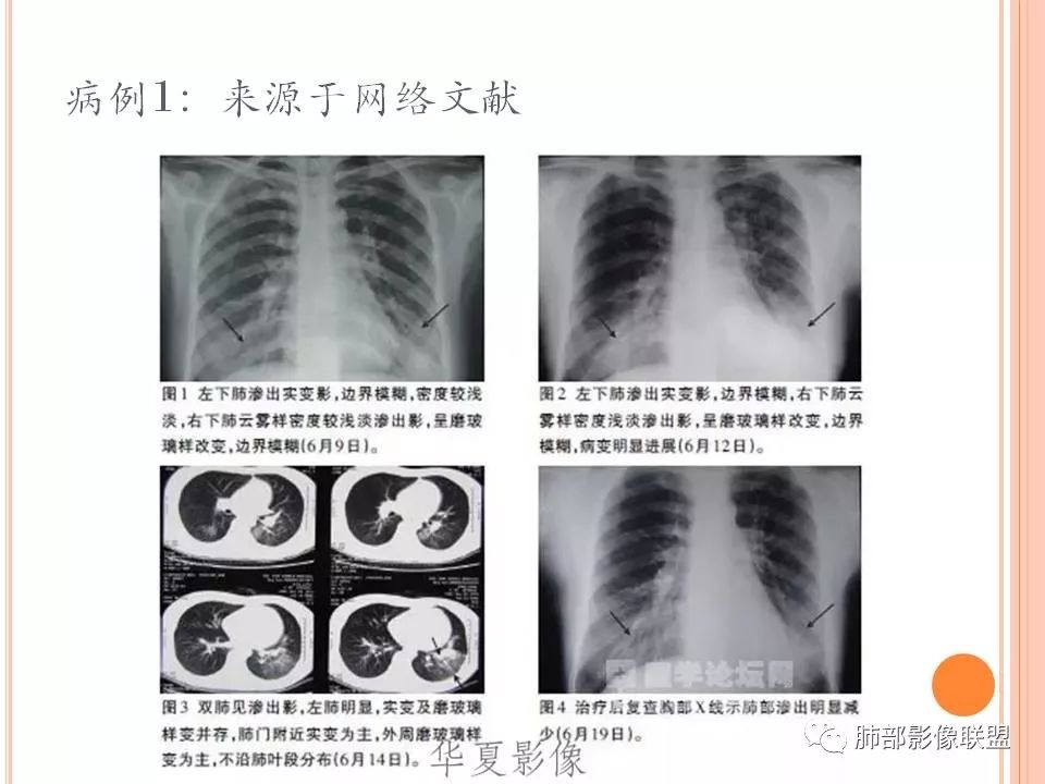 【PPT】支原体肺炎影像分析
