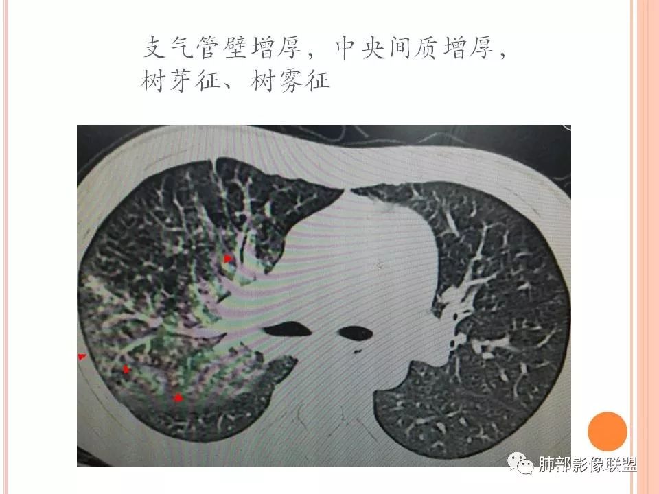 【PPT】支原体肺炎影像分析