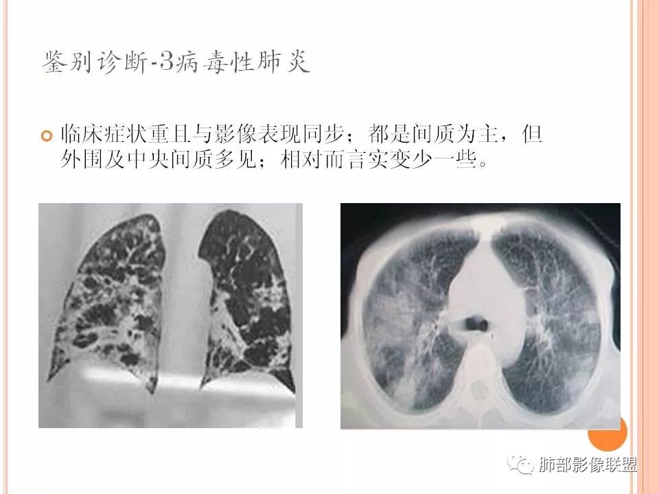 【PPT】支原体肺炎影像分析