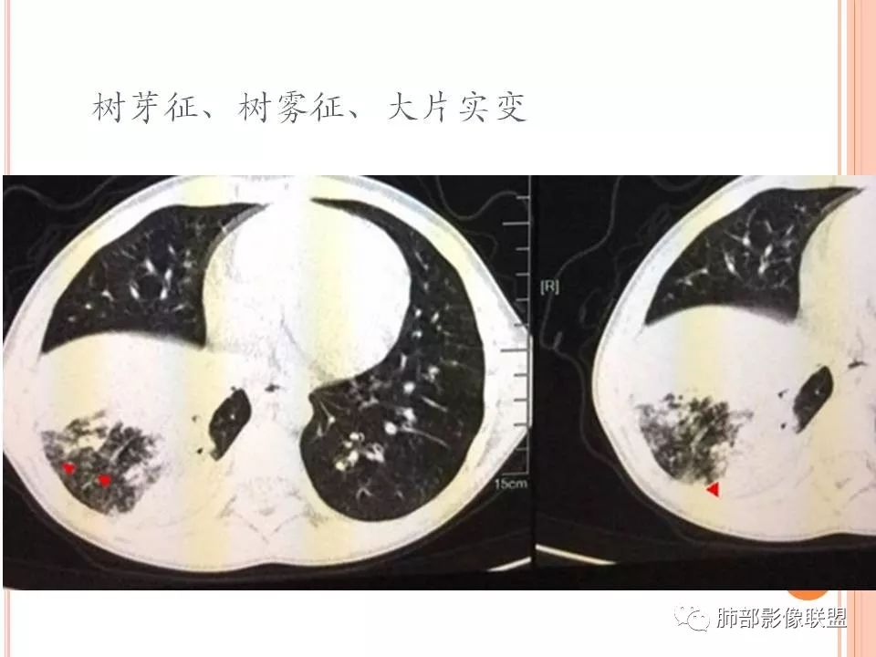 【PPT】支原体肺炎影像分析